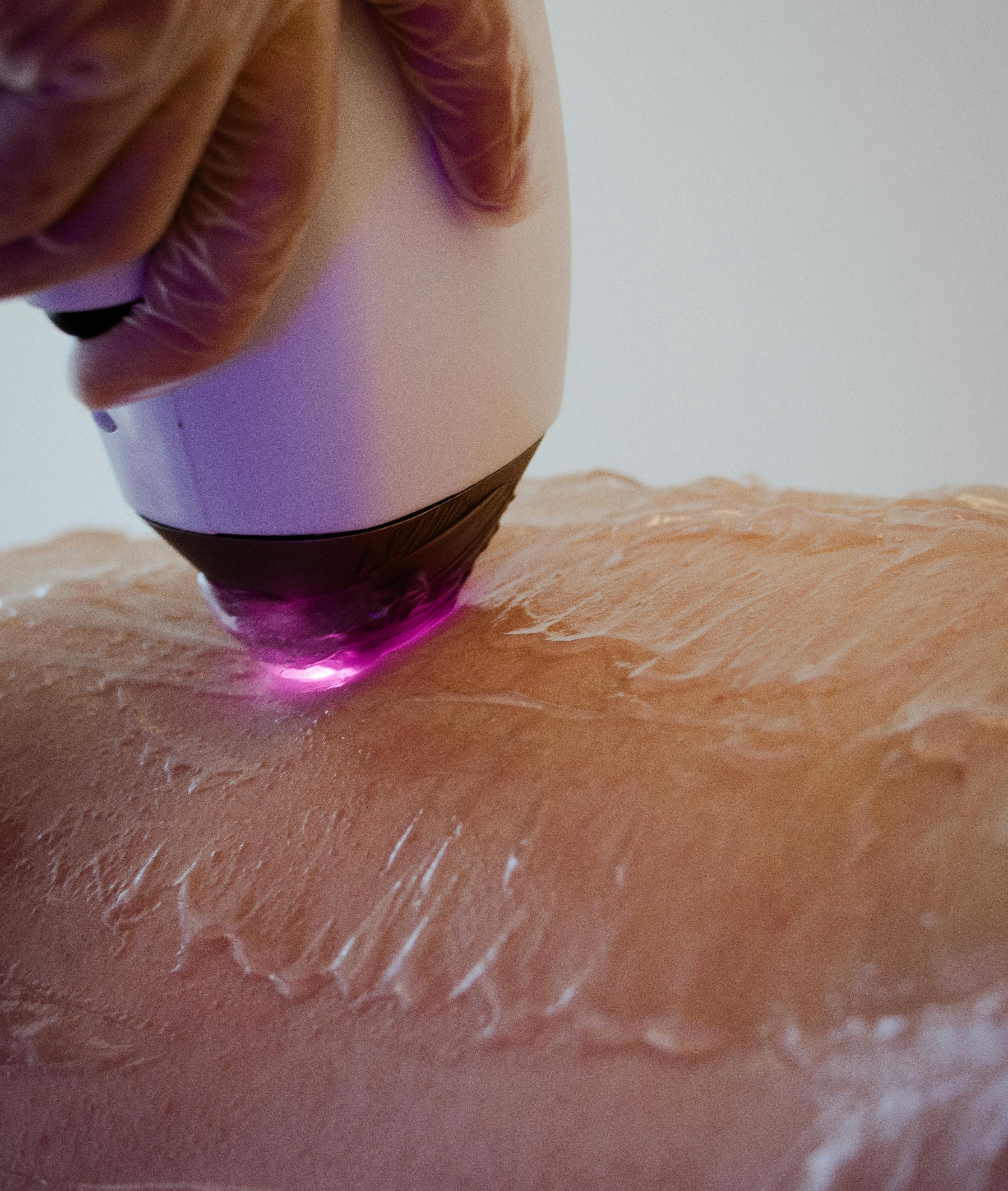 Laser Hair Removal